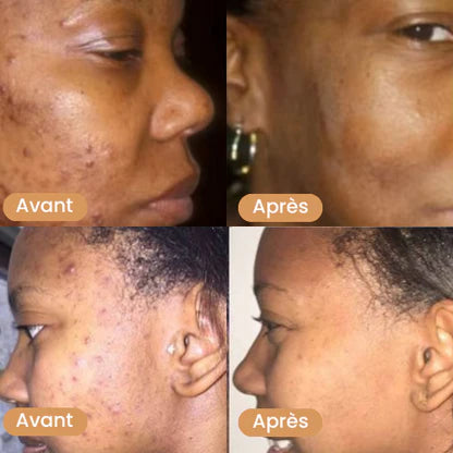 Savon overdose visage