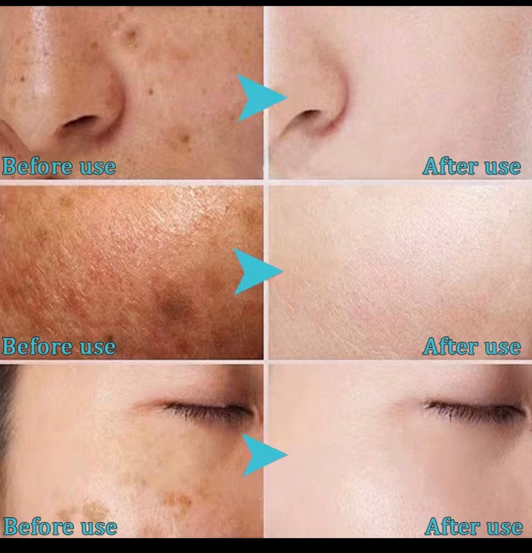 Crème Visage 
Éclaircissante Anti-Taches ,Élimine Mélasma, Taches d'Acné, Pigmentation, Mélanine et Taches Brunes, Crème Blanchissante Forte