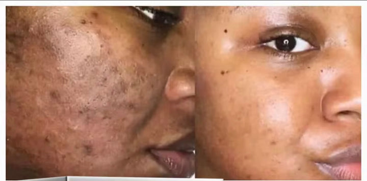 Crème Visage 
Éclaircissante Anti-Taches ,Élimine Mélasma, Taches d'Acné, Pigmentation, Mélanine et Taches Brunes, Crème Blanchissante Forte