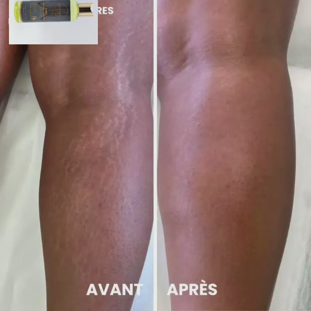 🌿 Huile Anti-Vergetures BINTHAIR – Soin réparateur 100% naturel