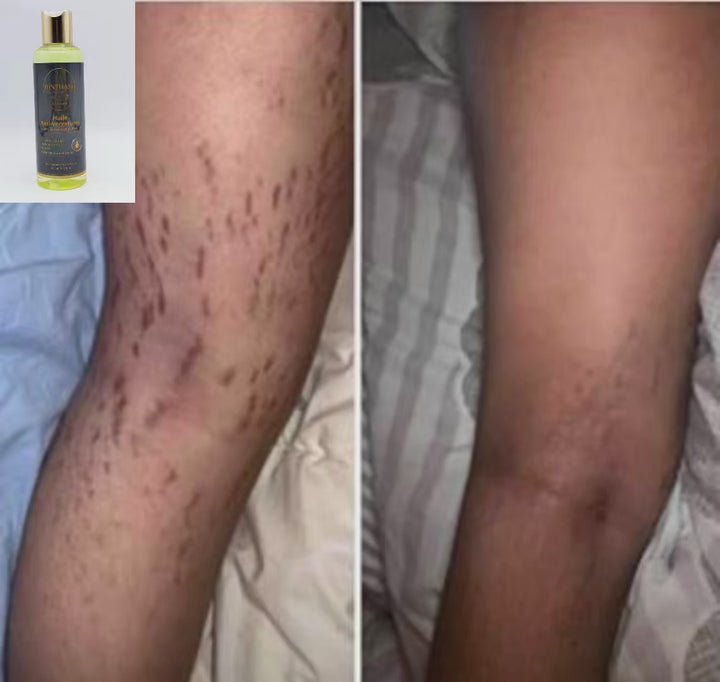 🌿 Huile Anti-Vergetures BINTHAIR – Soin réparateur 100% naturel